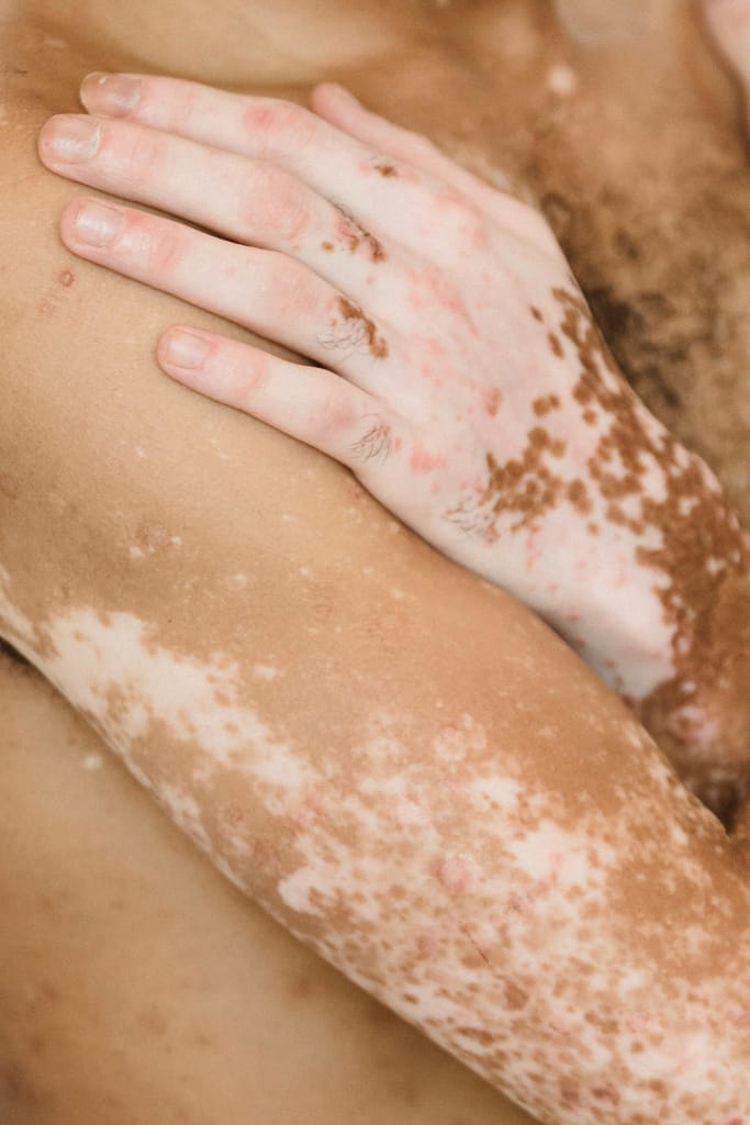 Le vitiligo